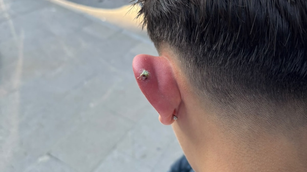 Bursa'da kulağına yaptırdığı piercing kabusu oldu: Aileden hata duyurusu