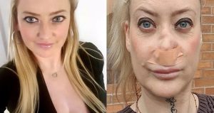 Antalya tatilinde dişlerini yaptıran turistin burnu çöktü!