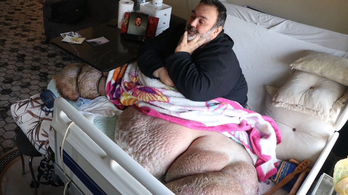 Kayseri’de fil hastası adam 300 kiloya ulaştı: 5 yıldır dışarı çıkamıyor