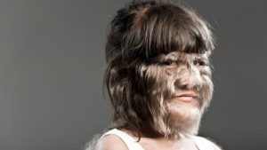 Nadir hastalıklara yüksek teknoloji umudu