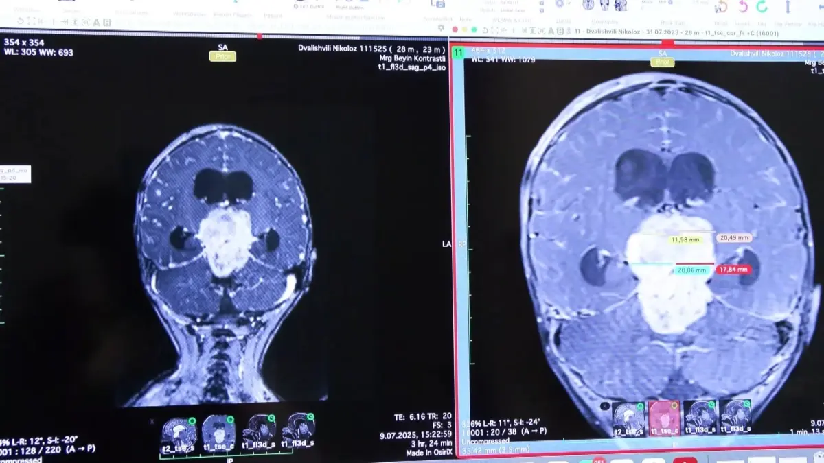 2.5 Yaşındaki Nikoloz’un Tümör Ameliyatı Başarıyla Gerçekleşti