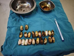 Eskişehir’de Uyuşturucu Kapsülleri Mideden Çıkarıldı