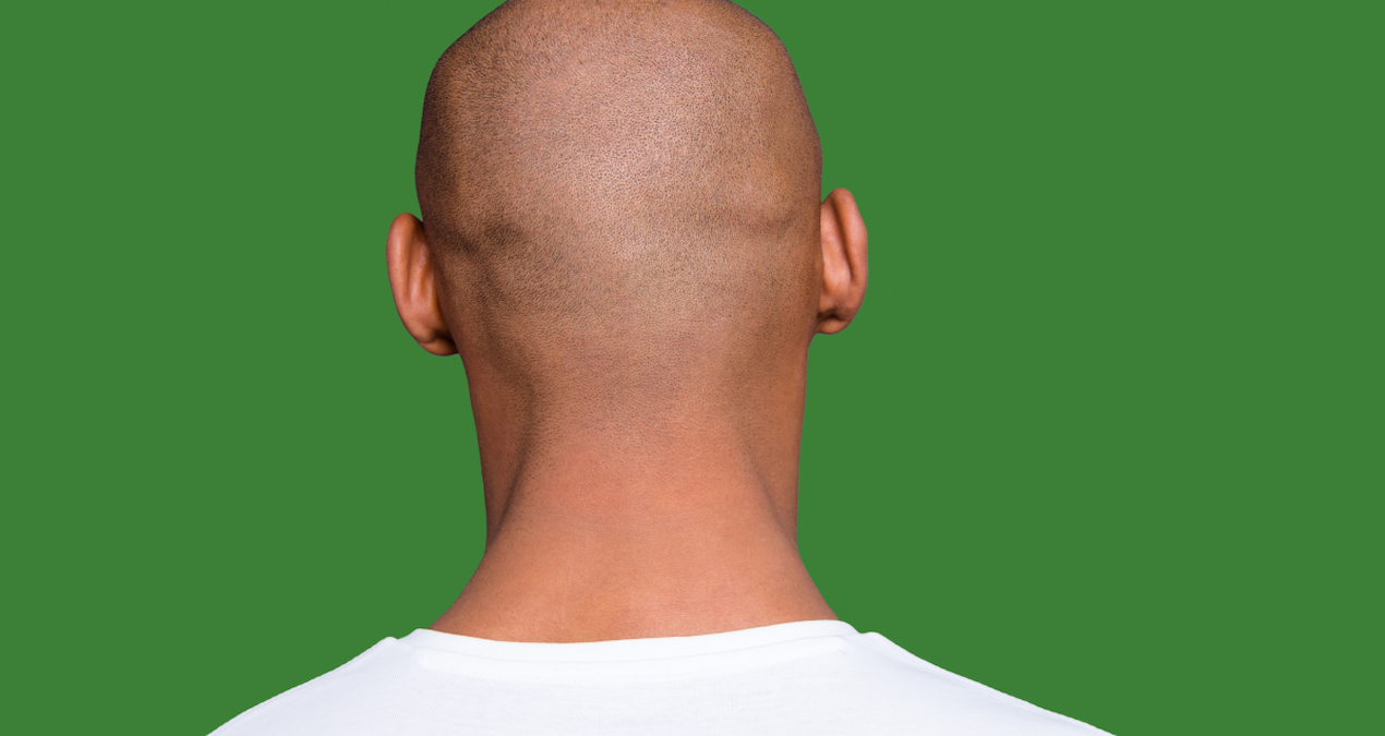 Kafa büyüklüğünüz, nörolojik hastalıklara yakalanma riskinizi gösteriyor