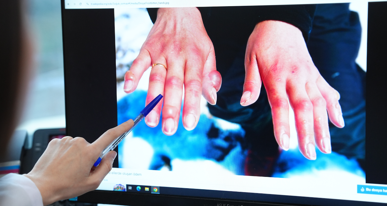 Kış aylarında vakalar patladı… Elinizde bu işaretleri görüyorsanız dikkat