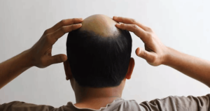 Kocasının kel olduğunu evlendikten sonra öğrendi: Soluğu karakolda aldı