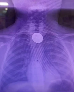 Siirt’te 8 Yaşındaki Çocuk Parayı Yuttu