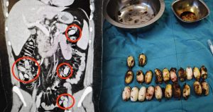 Yurt dışından geldi: Midesinden çıkanlar ağızları açık bıraktı