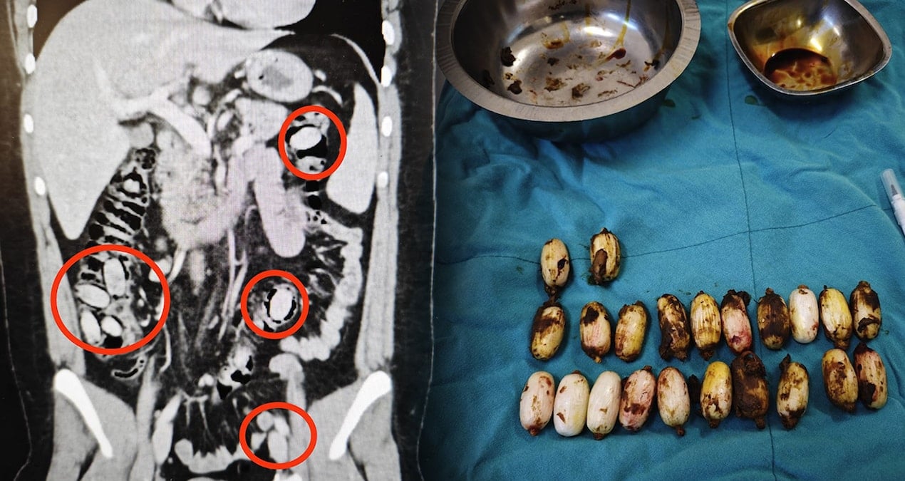 Yurt dışından geldi: Midesinden çıkanlar ağızları açık bıraktı