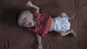 Gazze’de açlık: Filistinli bebeğin yaşam mücadelesi