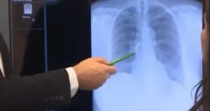 Kaplama dişleri uyurken akciğerine kaçtı