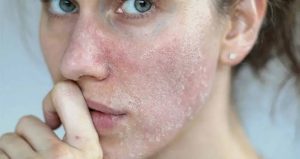 Soğuk havada cildinizdeki döküntülerin nedeni bu