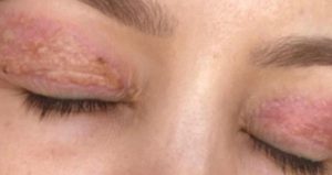 Ucuz estetik pahalıya patladı: Şimdi gözünü kapatamıyor