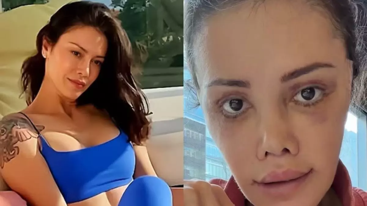 Yüz nakli yaptıran Didem Ceran’ın son hali: Harika gözüküyorum