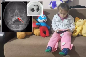 5 yaşındaki Polen yıllarca böyle yaşamış! Burnundan ameliyatla çıkardılar