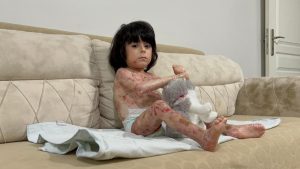 Bursa’da 4 yaşındaki İbrahim’in ‘kelebek hastalığı’ hayatını zorlaştırıyor