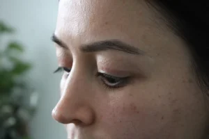 Göz Kapağı İşleminde Kalıcı Hasar